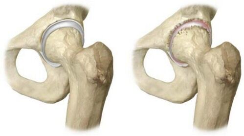 articulation de la hanche saine et atteinte d'arthrose